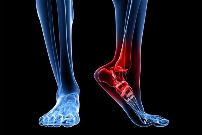 artroza stopala
