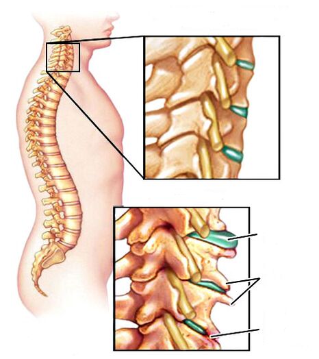 Kako izgleda osteohondroza