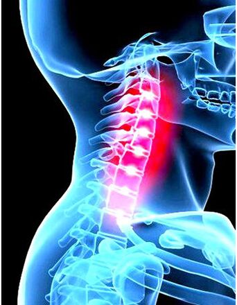 Klinička slika osteohondroze
